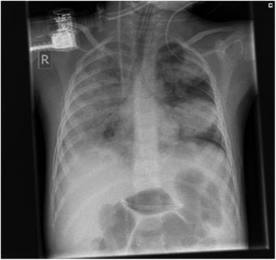 Case report: Rhabdomyolysis in children in acute and chronic disease—a challenging condition in pediatric emergency medicine